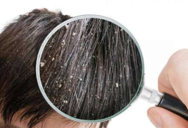 ما هي العلاقة بين قشرة الرأس وتساقط الشعر؟.. إليك الإجابة