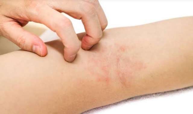 علاج حساسية الجلد