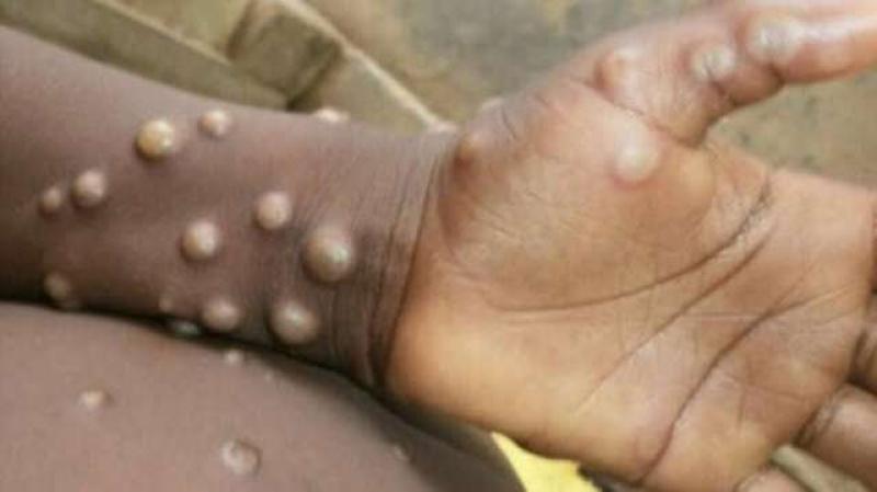دولة كبري تُعلن تسجيل أول حالة إصابة بفيروس جدري القرود