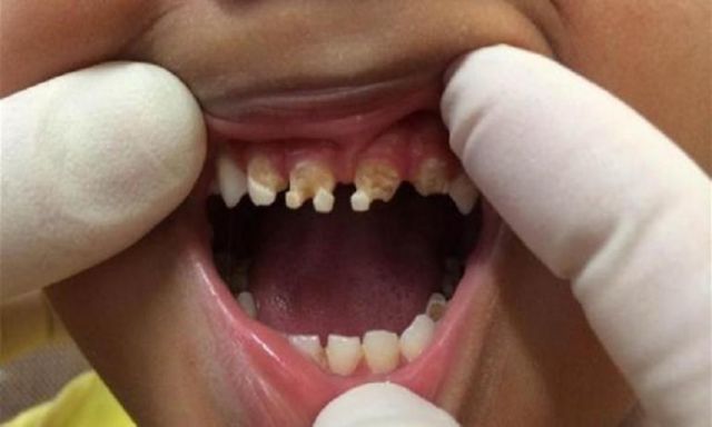 هذا ما يحدث لأسنان الأطفال المدمنين على المشروبات الغازية
