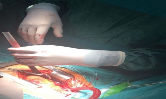 الصحة: إجراء أول عملية قلب مفتوح بمحافظة جنوب سيناء فى مستشفى شرم الشيخ الدولى