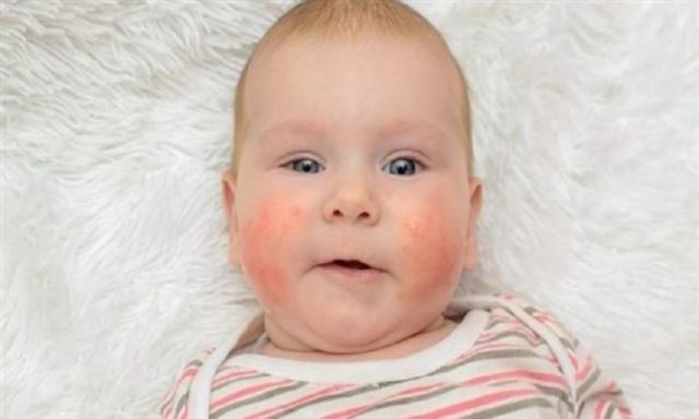 أعراض يجب الانتباه لها تكشف إصابة الطفل بحساسية القمح والشعير