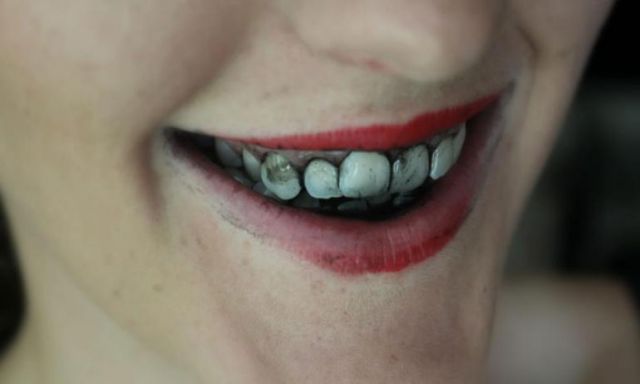 دراسة حديثة تكشف خطورة استخدام  معاجين ”الفحم” فى تنظيف الأسنان